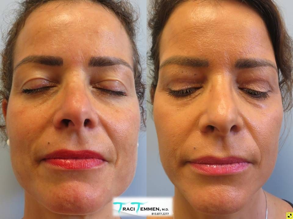 Eyelid Surgery Before & After