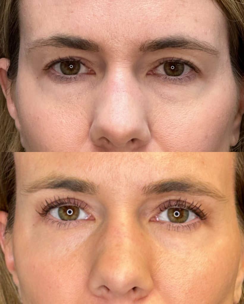 Eyelid Surgery Before & After