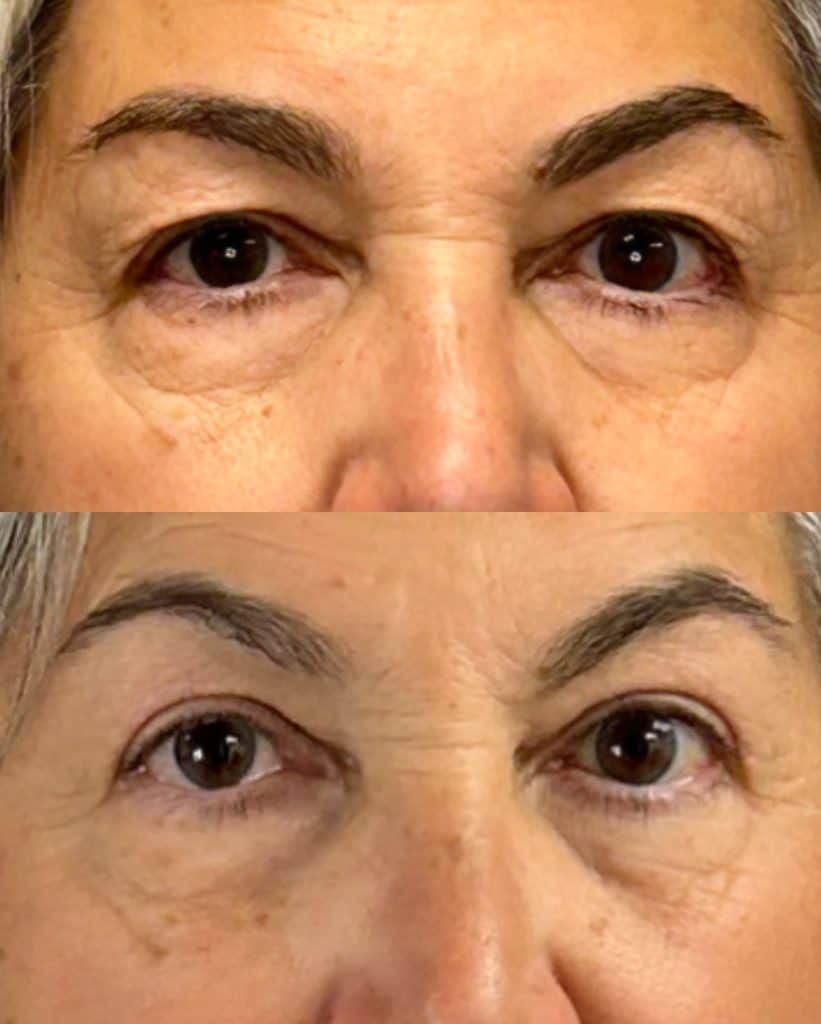 Eyelid Surgery Before & After
