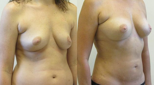 Natural Breast Augmentation Before & After