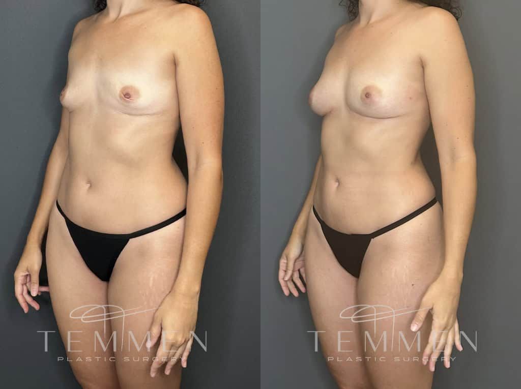 Natural Breast Augmentation Before & After