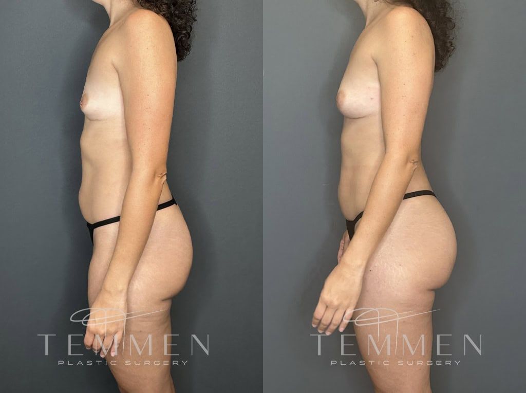 Natural Breast Augmentation Before & After