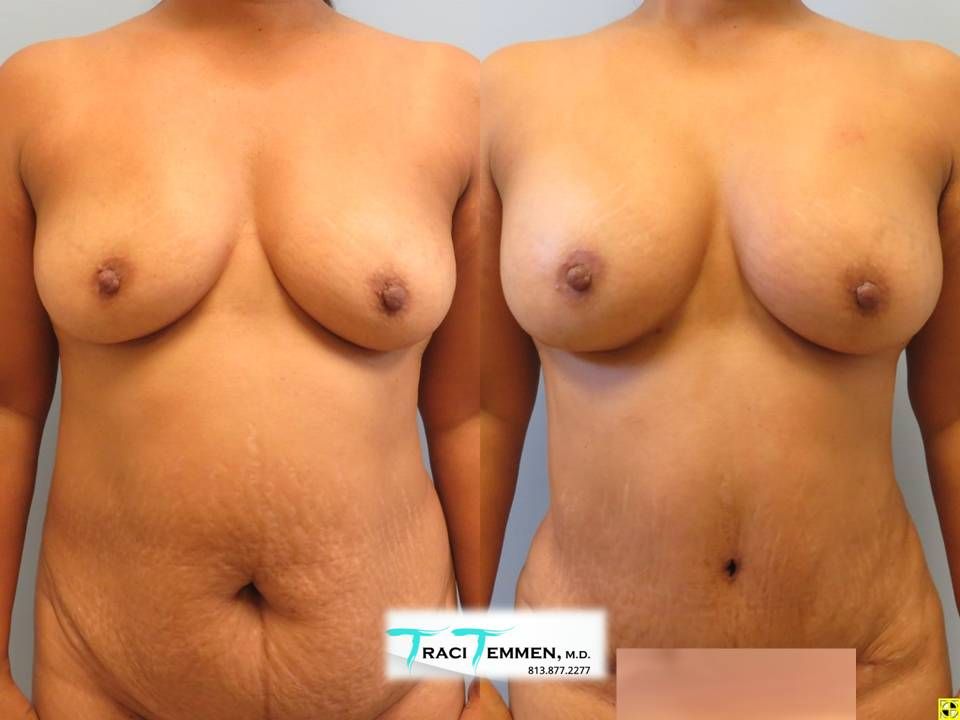 Natural Breast Augmentation Before & After
