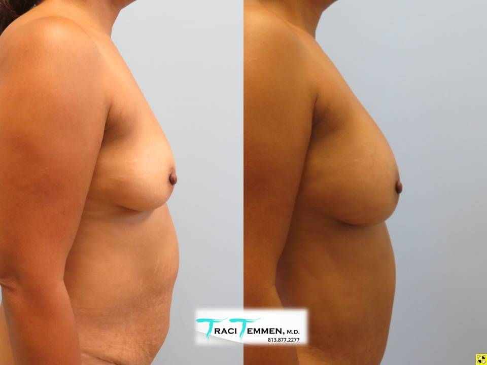 Natural Breast Augmentation Before & After