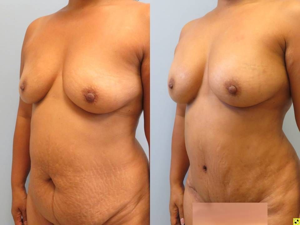 Natural Breast Augmentation Before & After