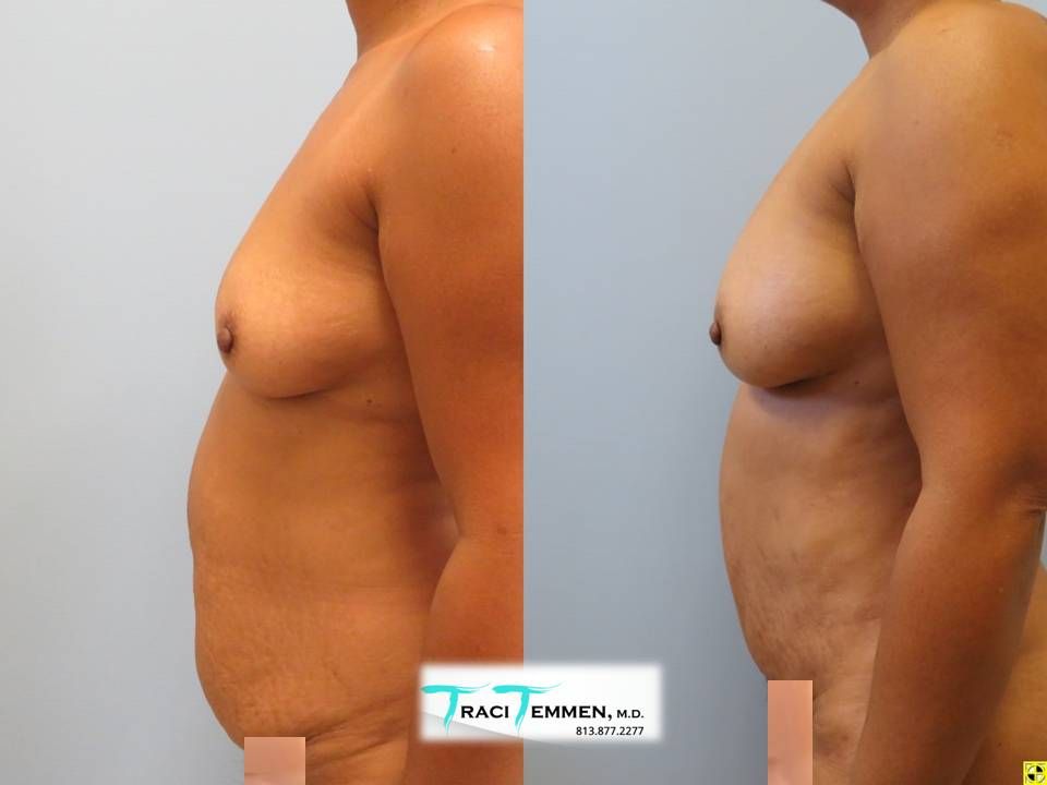 Natural Breast Augmentation Before & After