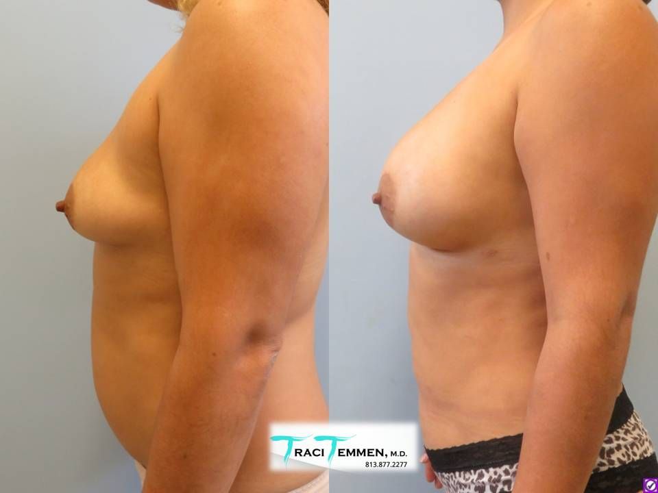 Natural Breast Augmentation Before & After