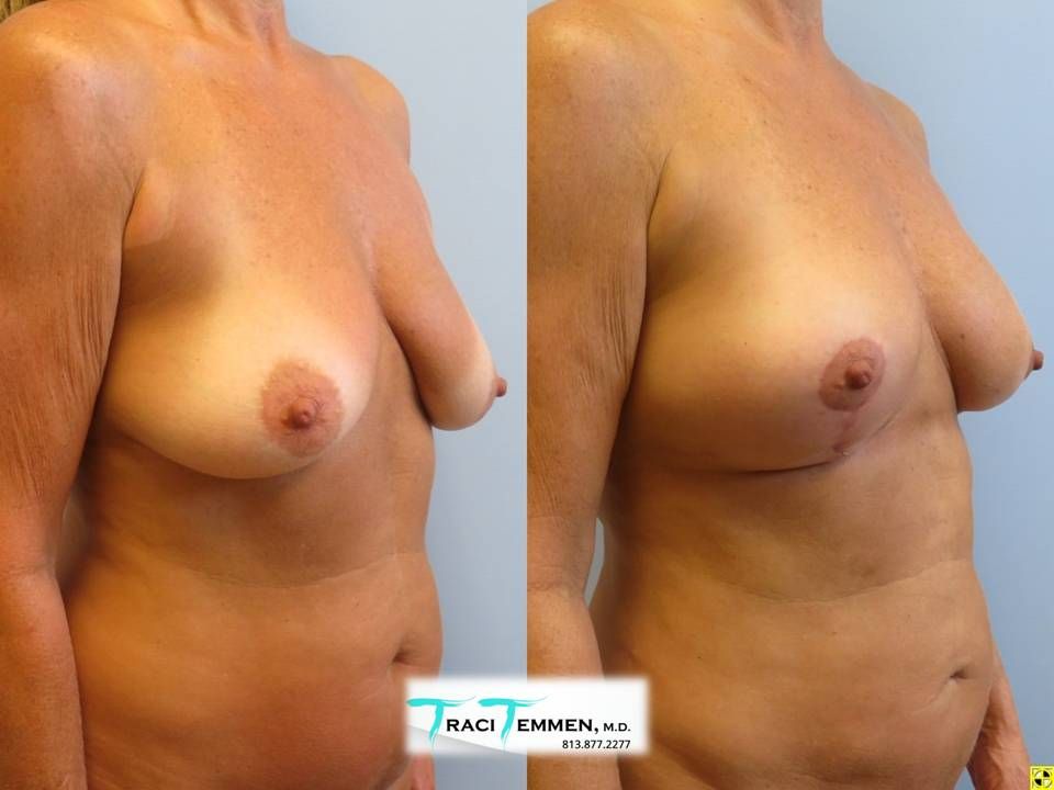 Natural Breast Augmentation Before & After