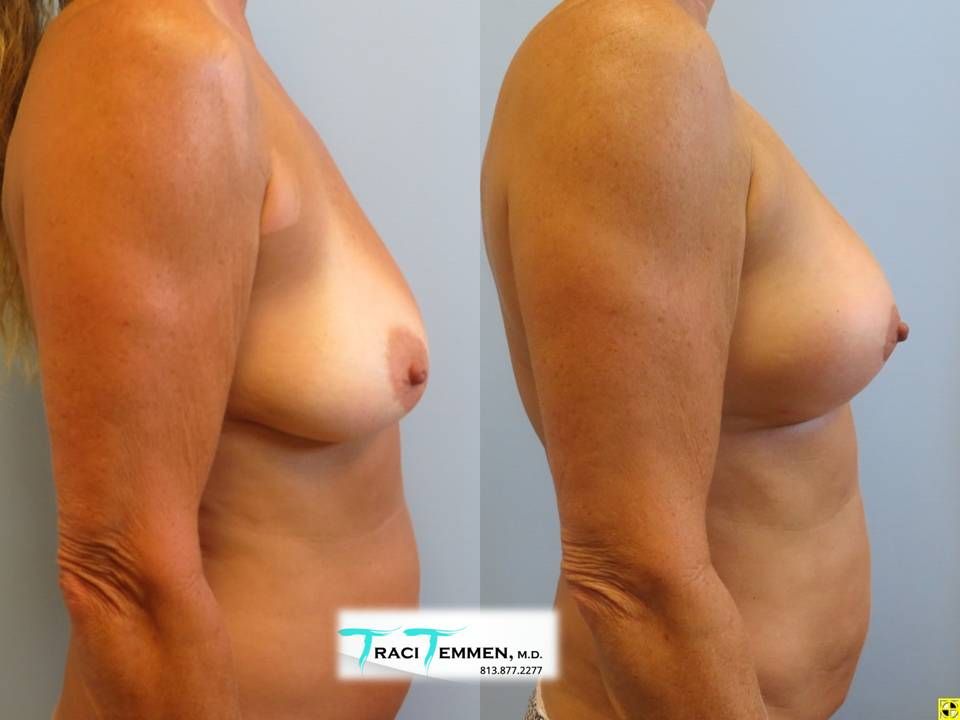 Natural Breast Augmentation Before & After