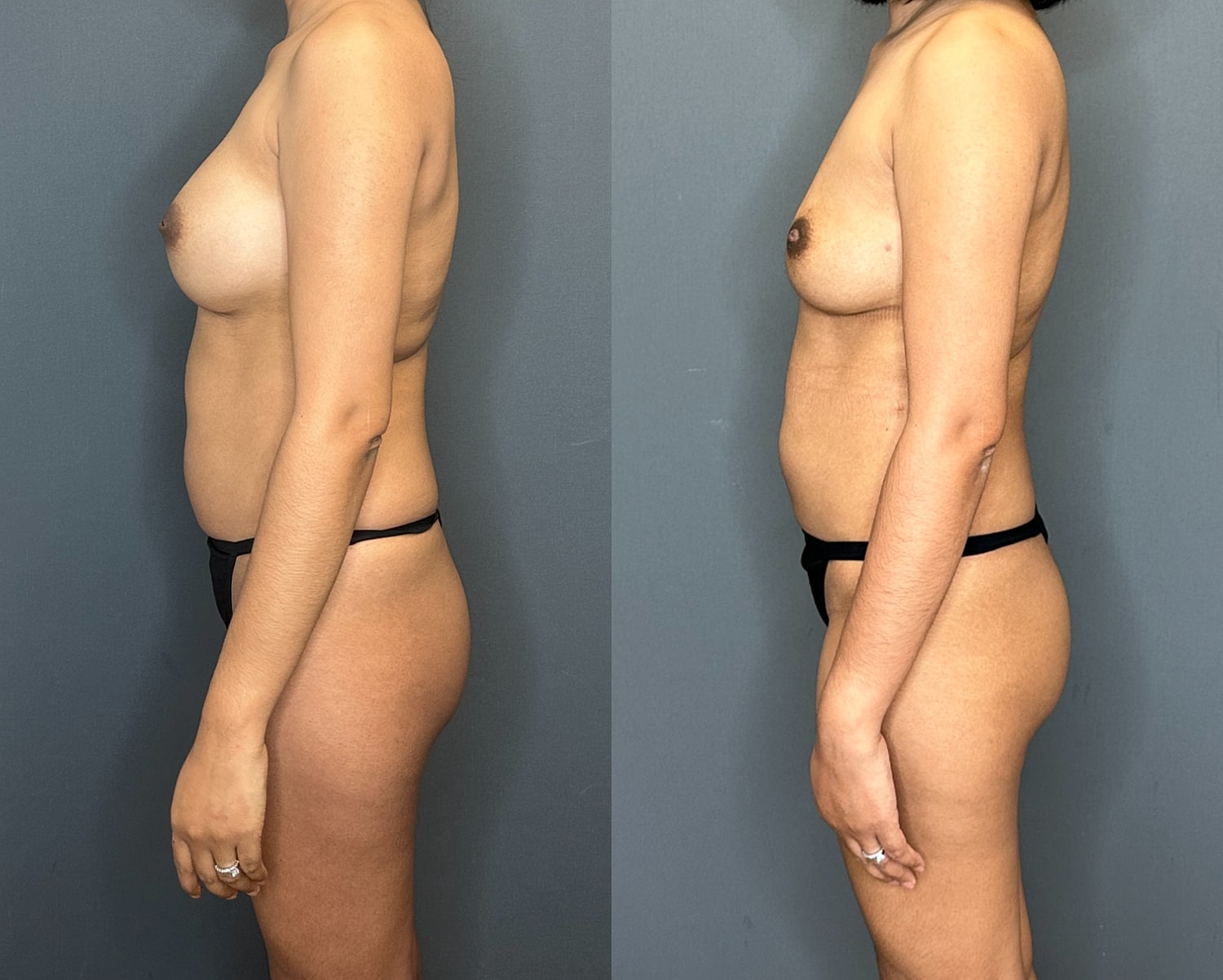 Natural Breast Augmentation Before & After