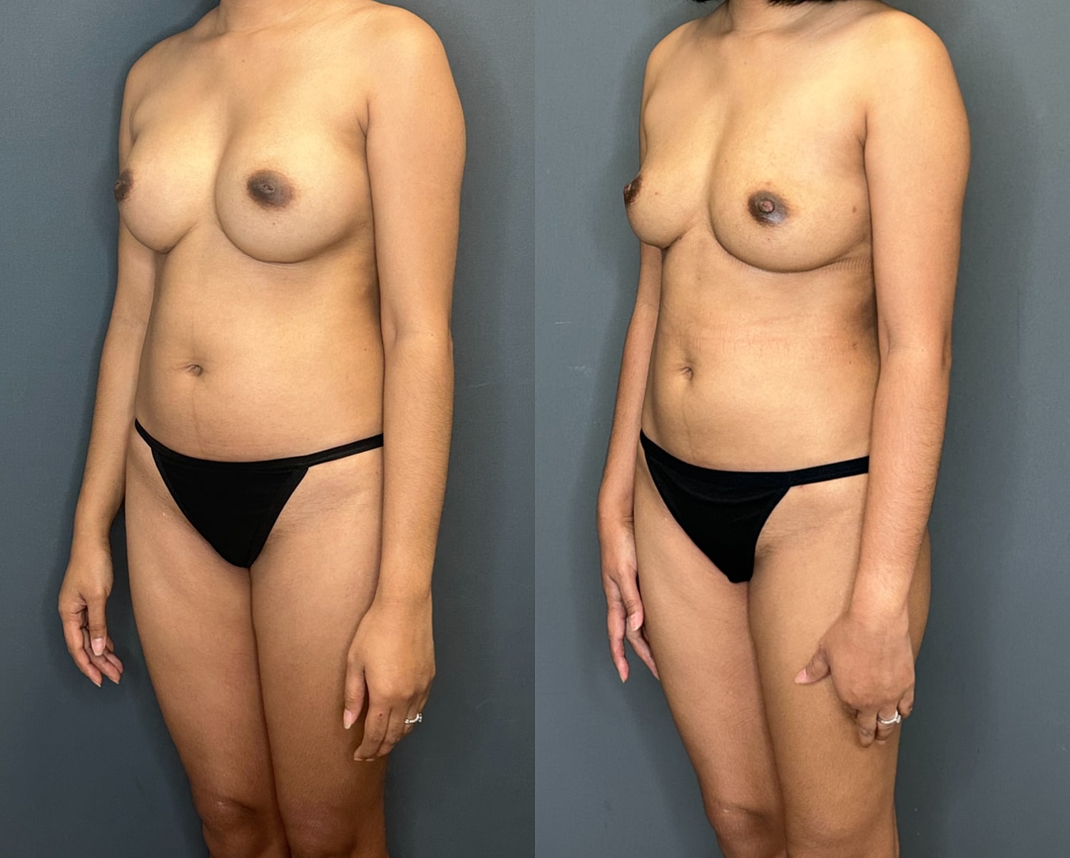 Natural Breast Augmentation Before & After