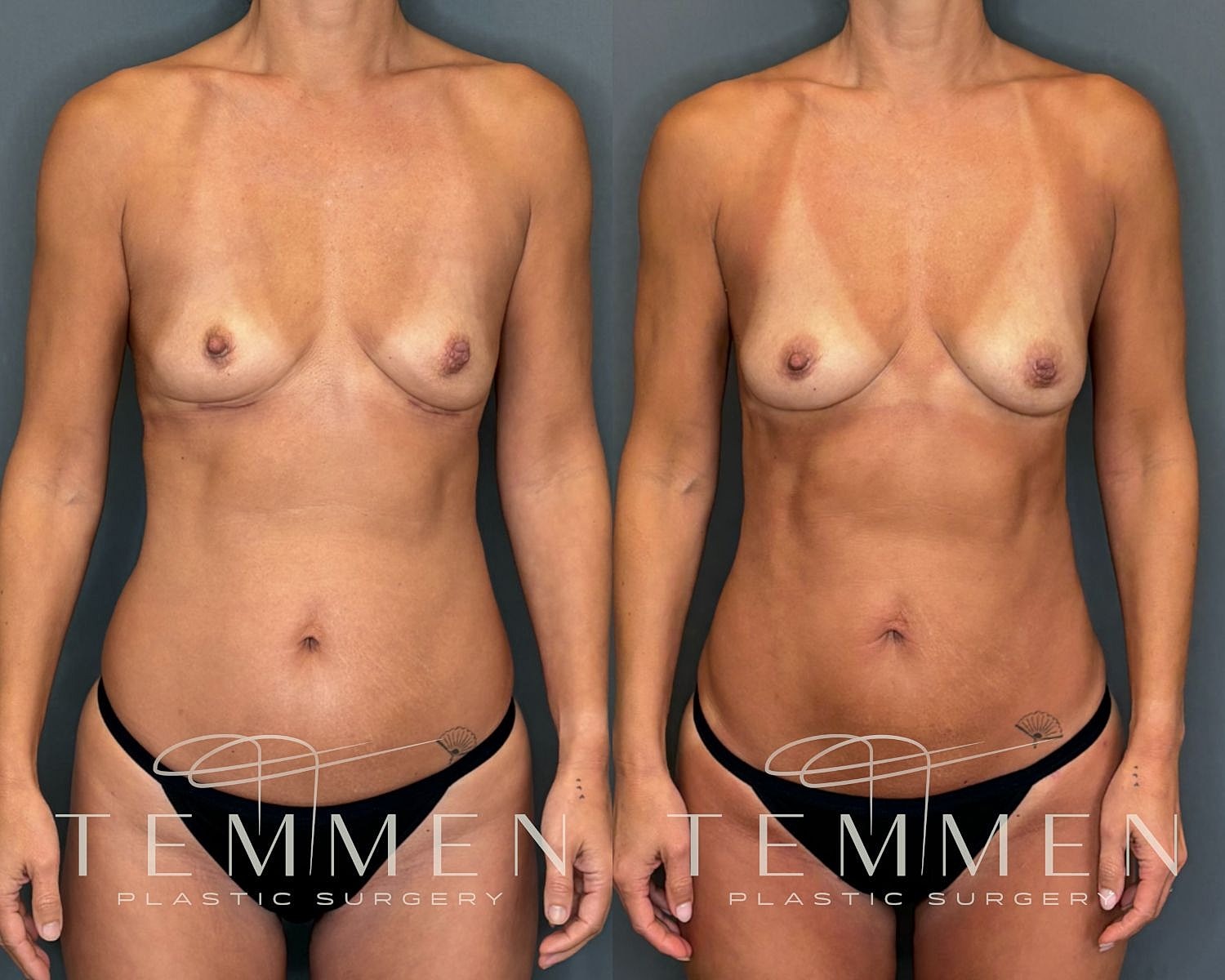 Natural Breast Augmentation Before & After