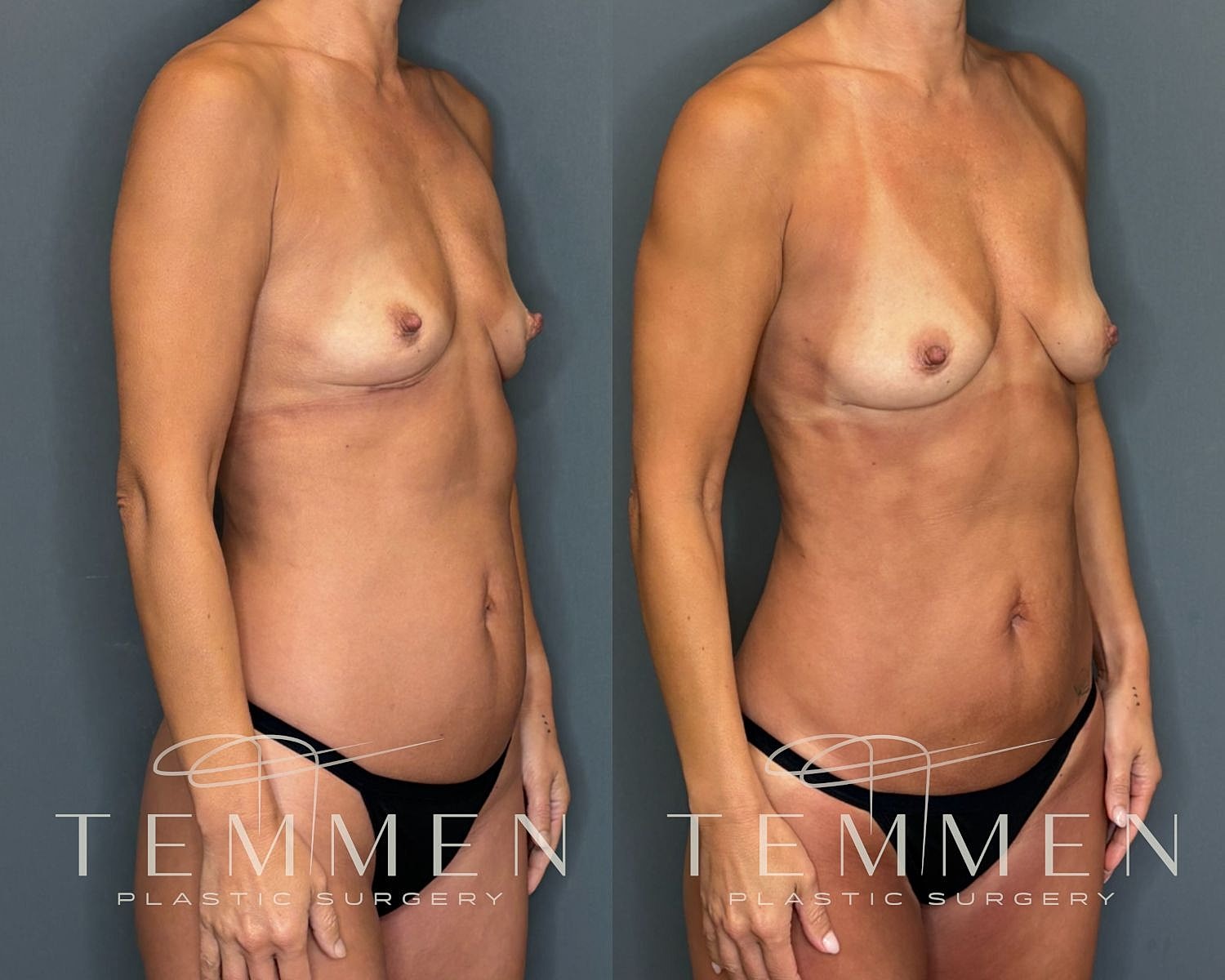 Natural Breast Augmentation Before & After