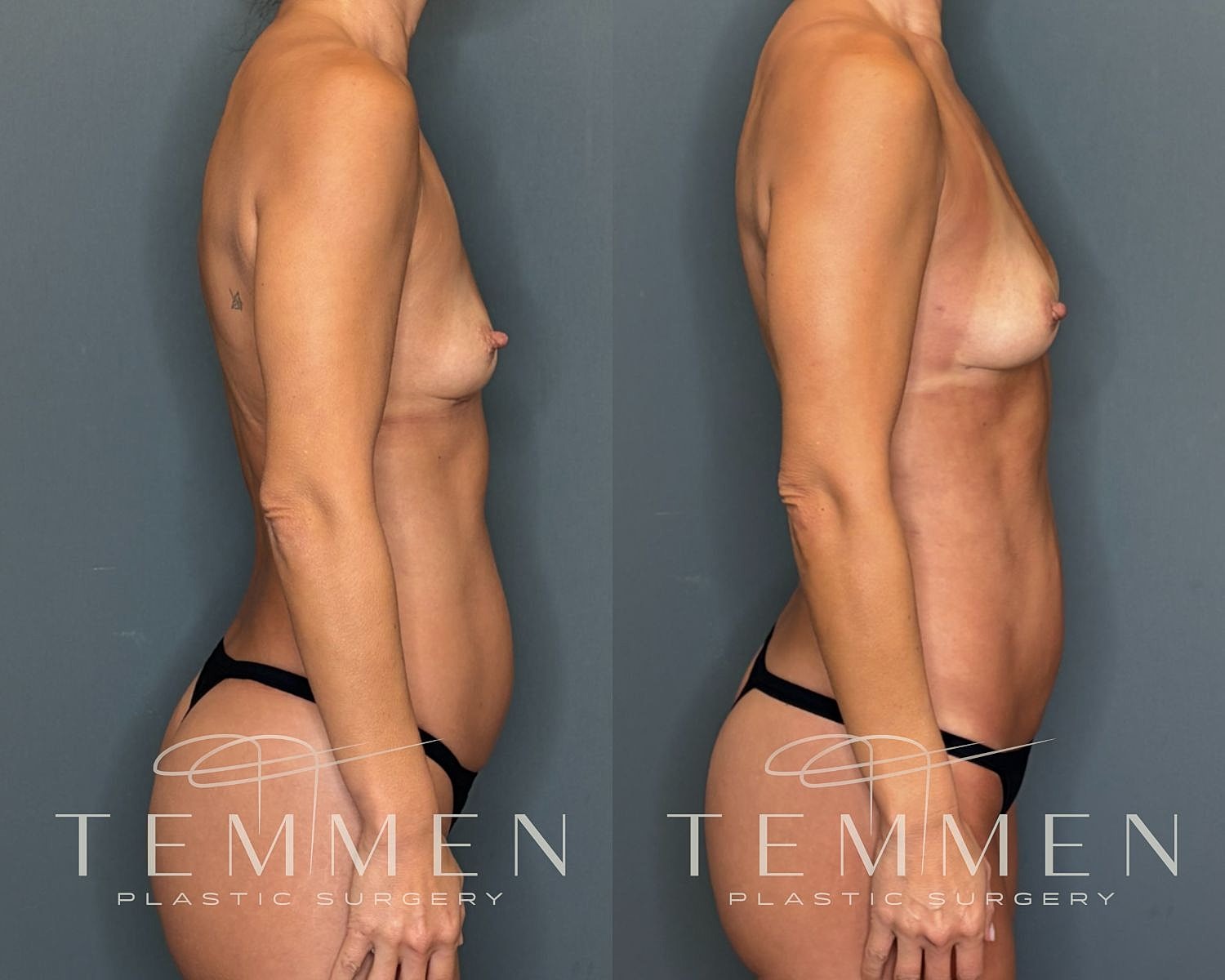 Natural Breast Augmentation Before & After