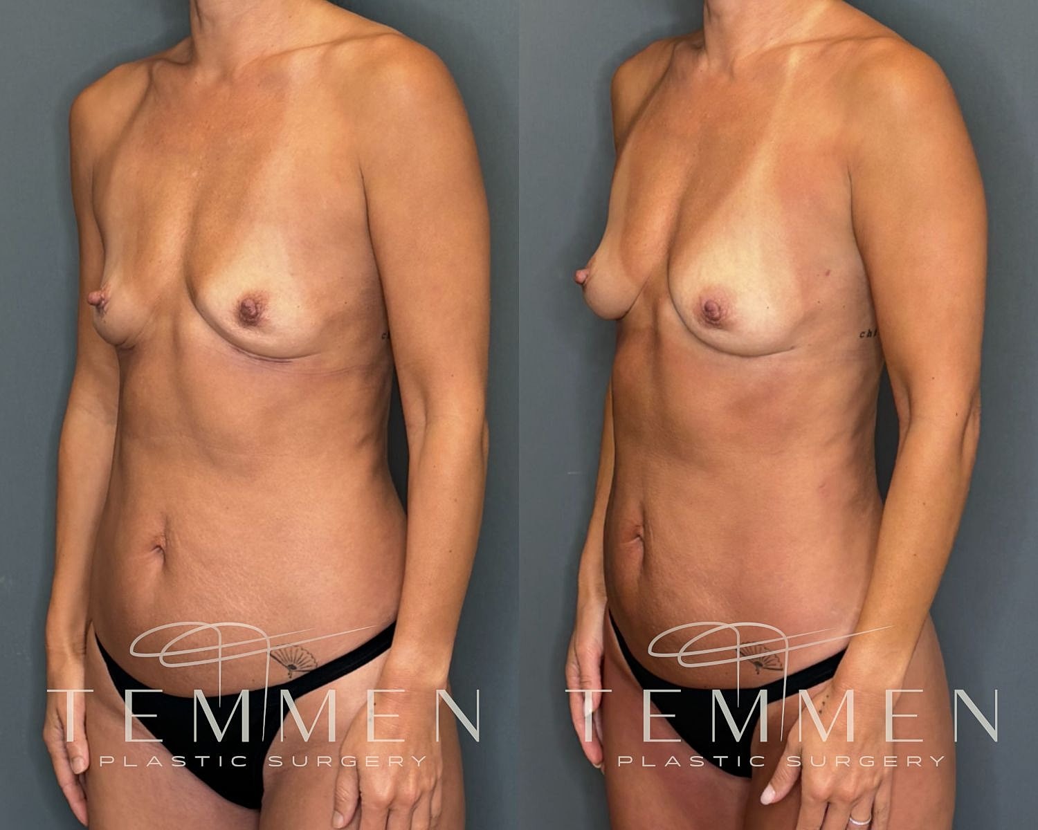 Natural Breast Augmentation Before & After