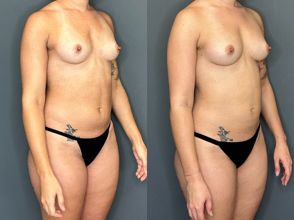 Natural Breast Augmentation Before & After