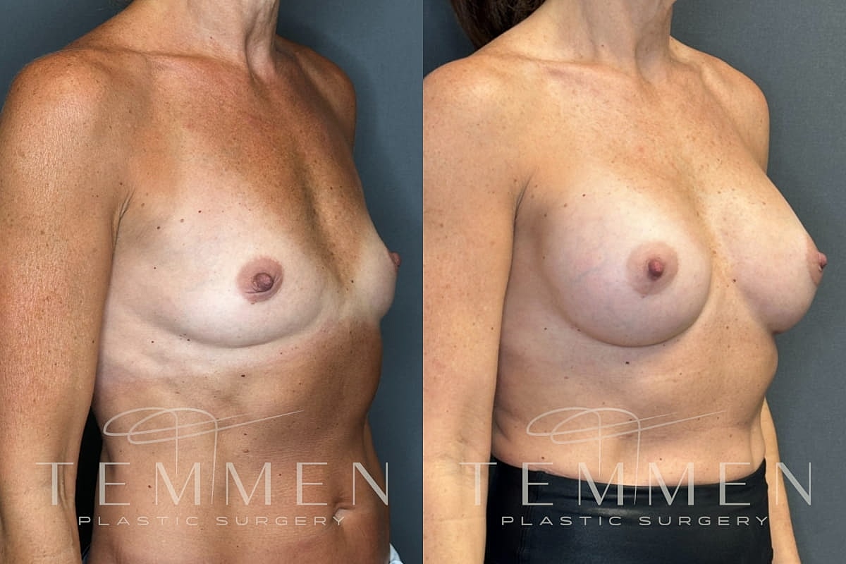 Natural Breast Augmentation Before & After