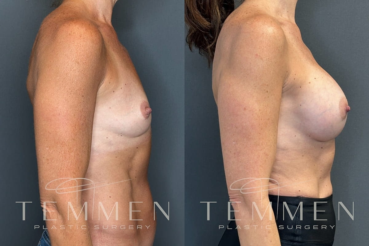 Natural Breast Augmentation Before & After