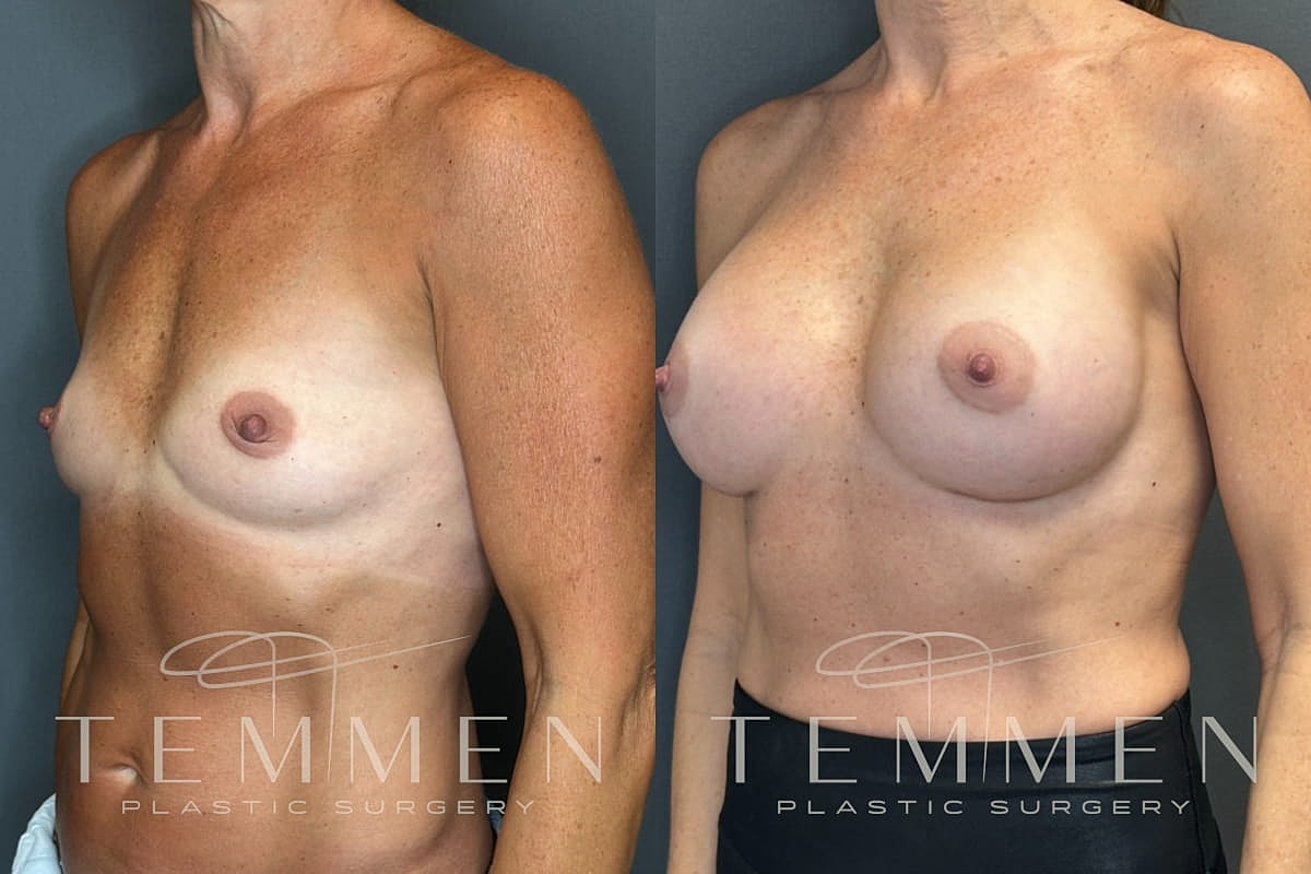 Natural Breast Augmentation Before & After