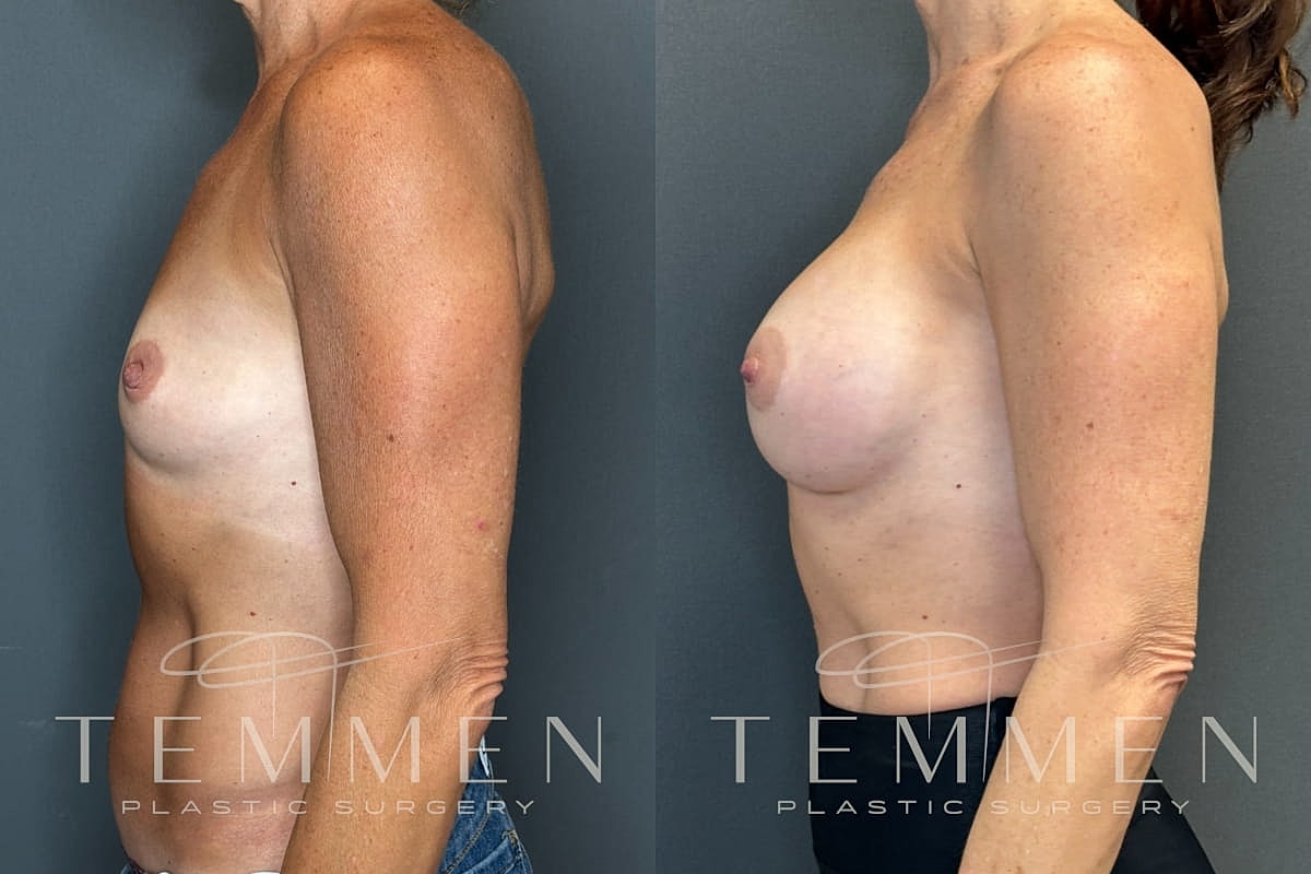 Natural Breast Augmentation Before & After