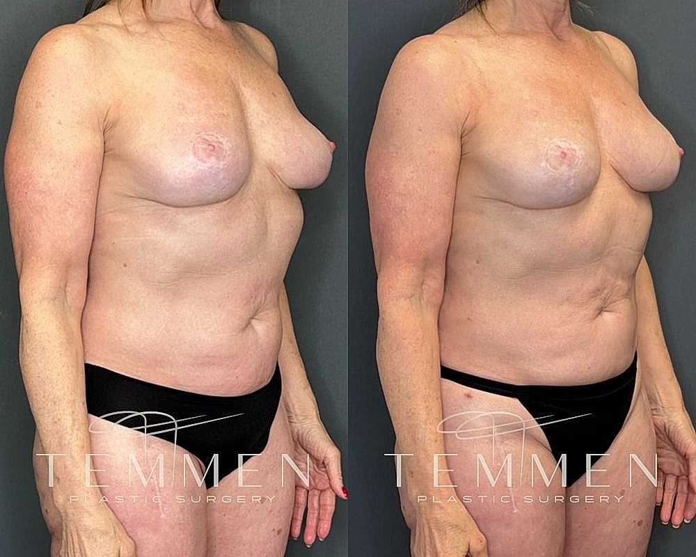 Before and after plastic surgery side view comparison.