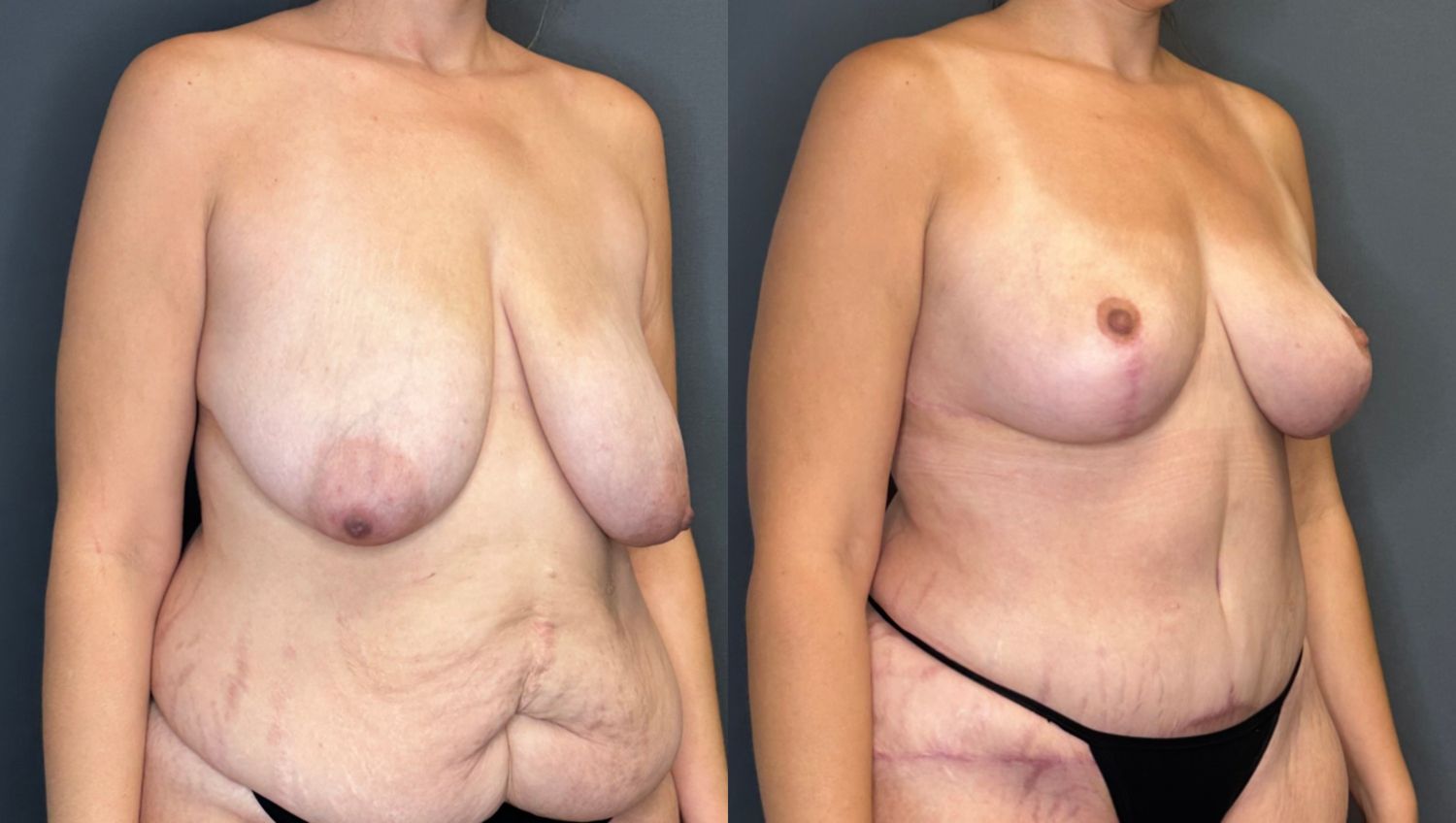 Natural Breast Augmentation Before & After