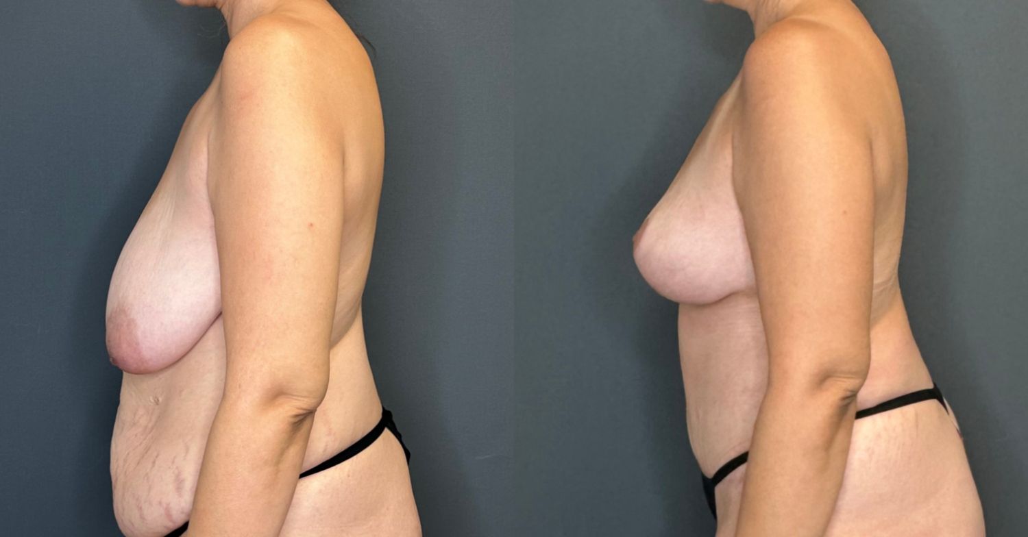 Natural Breast Augmentation Before & After