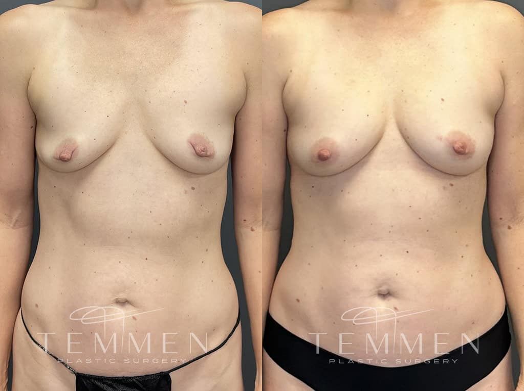 Natural Breast Augmentation Before & After