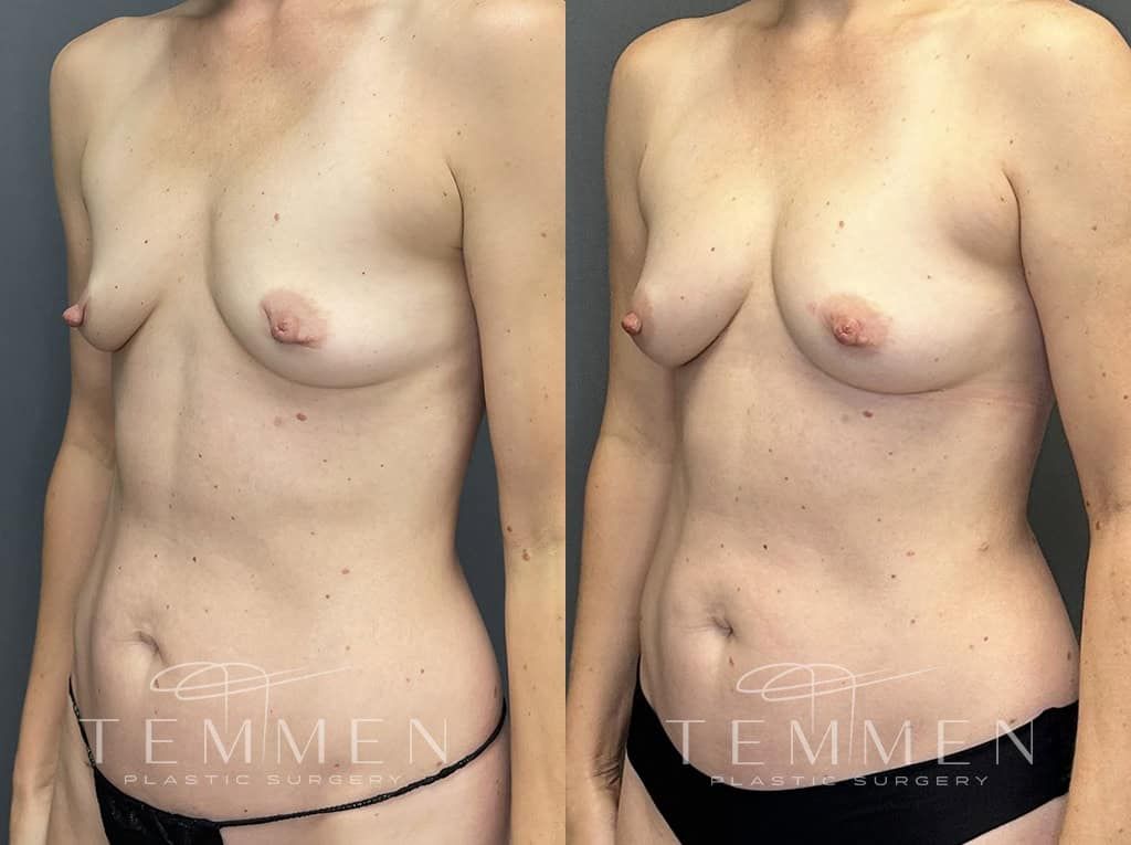 Natural Breast Augmentation Before & After