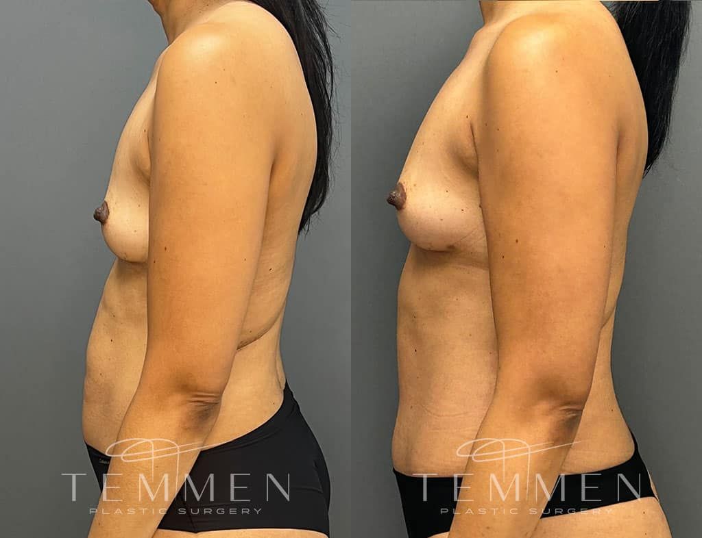 Natural Breast Augmentation Before & After