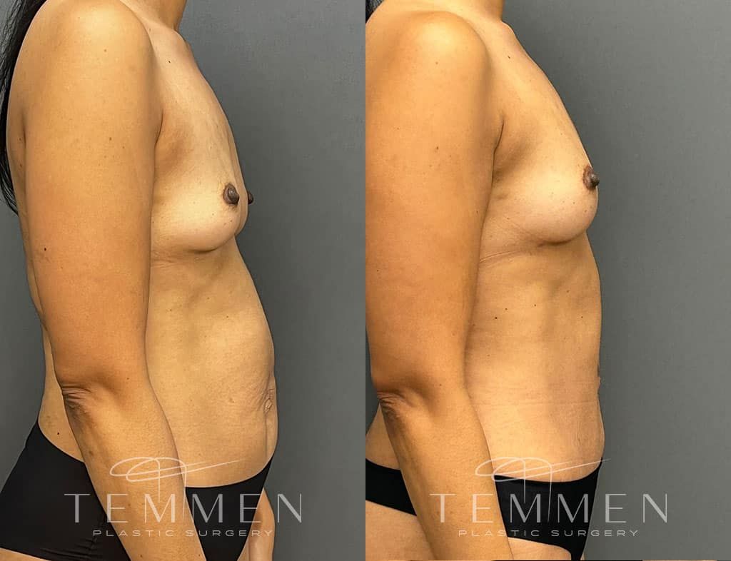 Natural Breast Augmentation Before & After