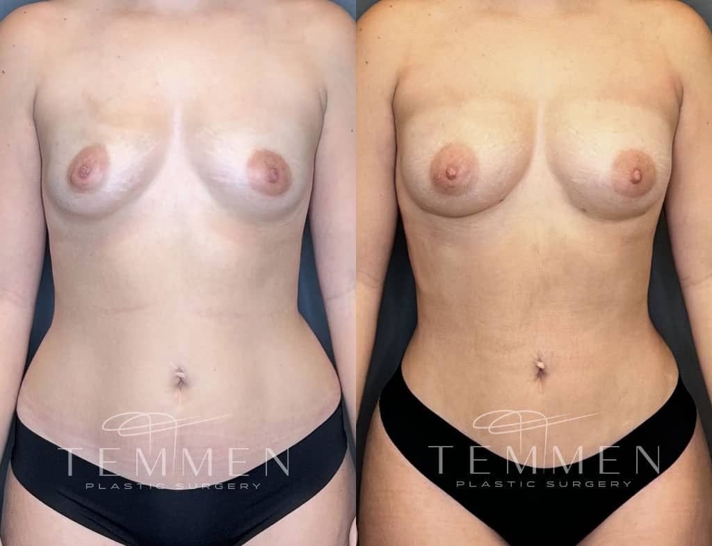Natural Breast Augmentation Before & After