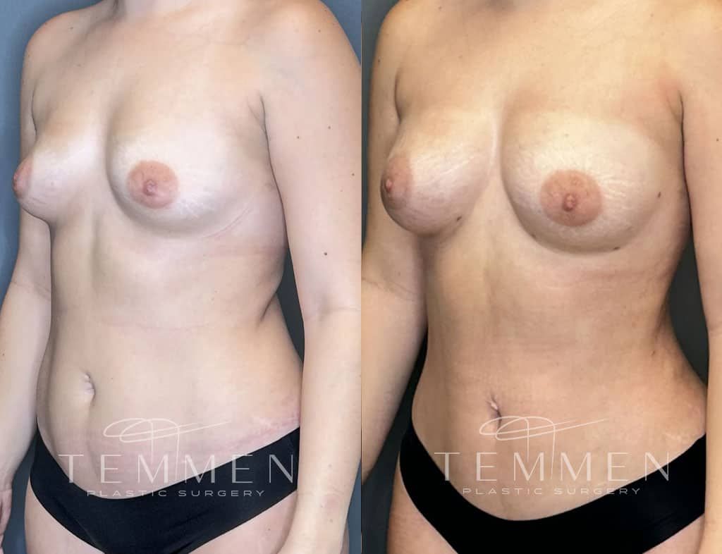 Natural Breast Augmentation Before & After