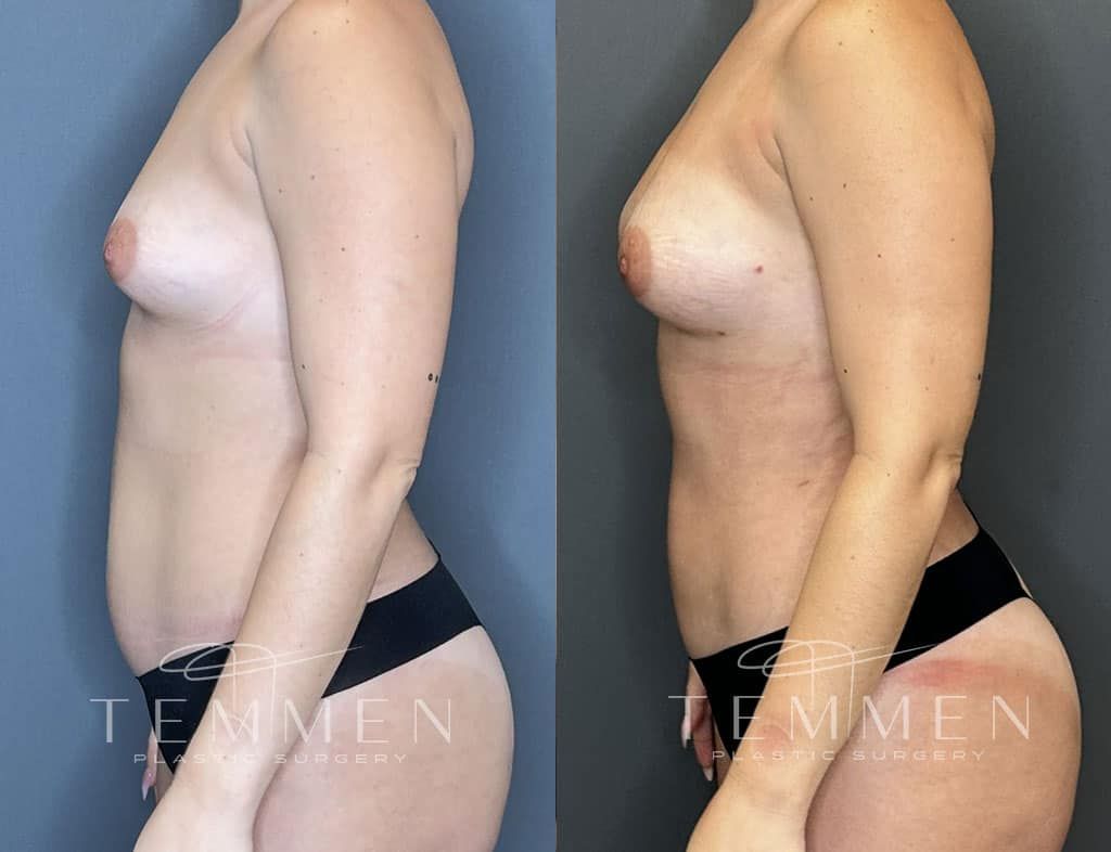 Natural Breast Augmentation Before & After
