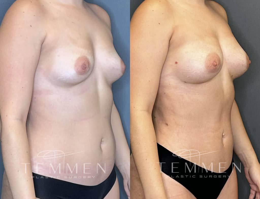 Natural Breast Augmentation Before & After