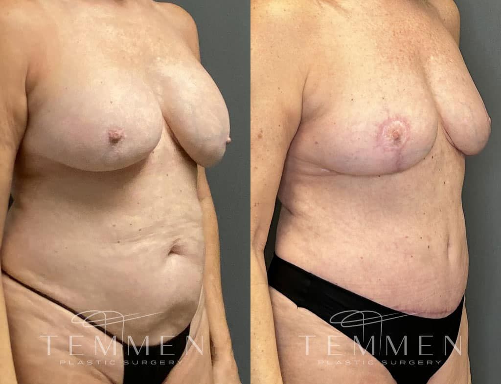Breast Implant Removal Breast Lift Liposuction Fat Transfer To The Breasts And Tummy Tuck Before & After