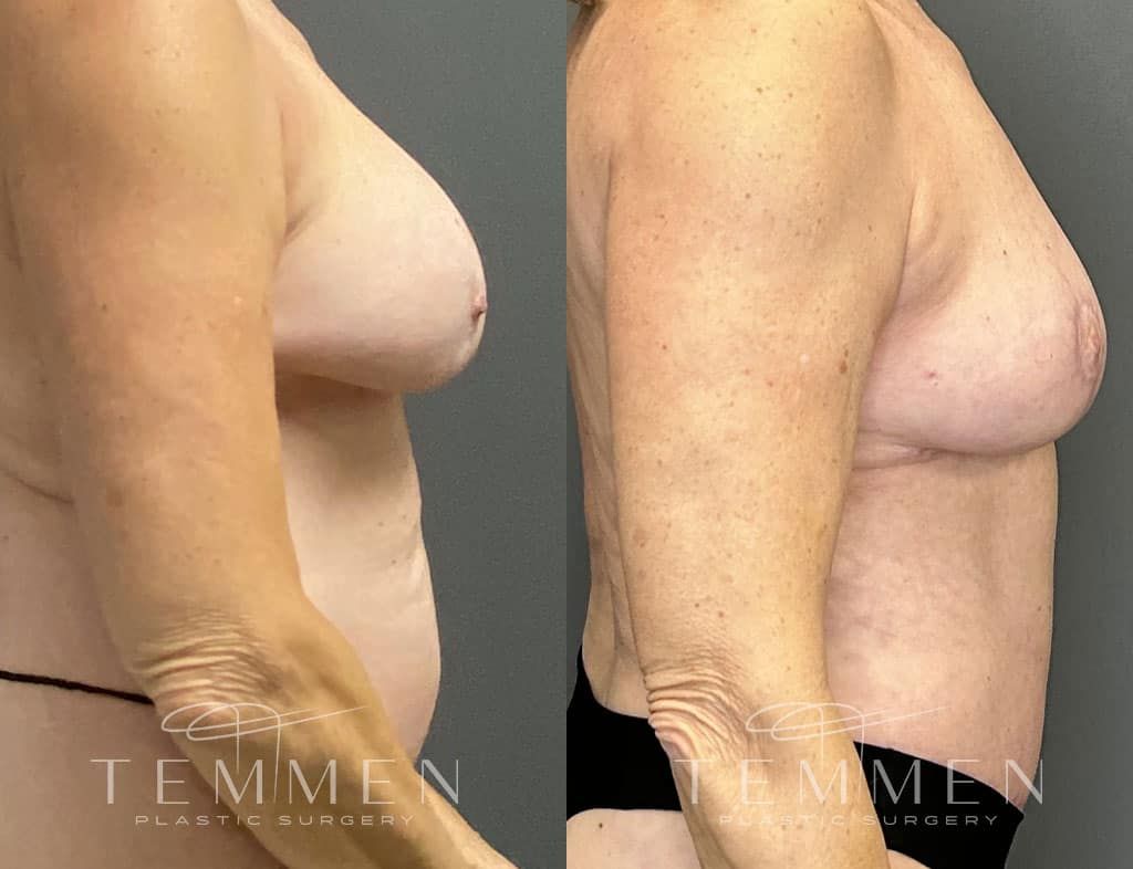 Breast Implant Removal Breast Lift Liposuction Fat Transfer To The Breasts And Tummy Tuck Before & After