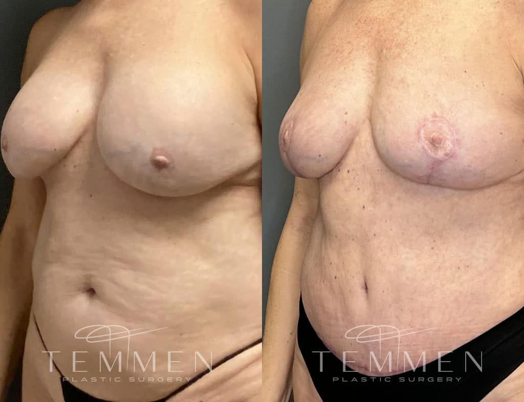 Breast Implant Removal Breast Lift Liposuction Fat Transfer To The Breasts And Tummy Tuck Before & After