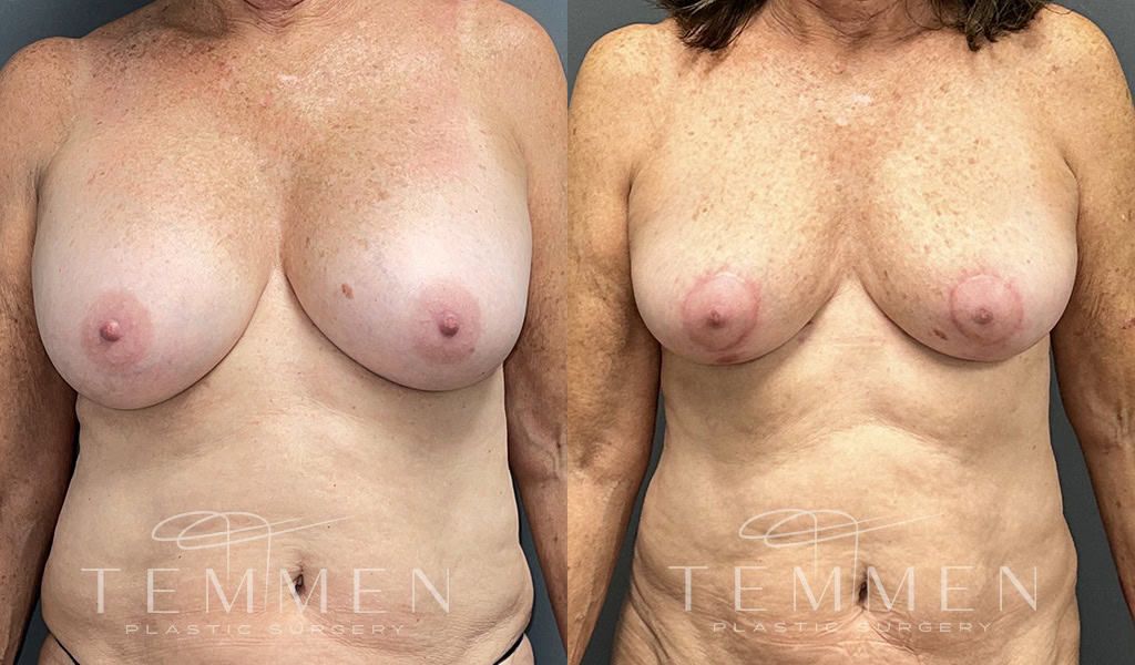 Breast Implant Removal Breast Lift Liposuction Fat Transfer To The Breasts And Tummy Tuck Before & After