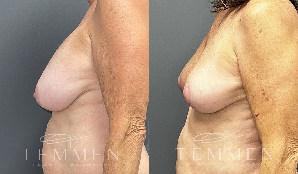 Breast Implant Removal Breast Lift Liposuction Fat Transfer To The Breasts And Tummy Tuck Before & After