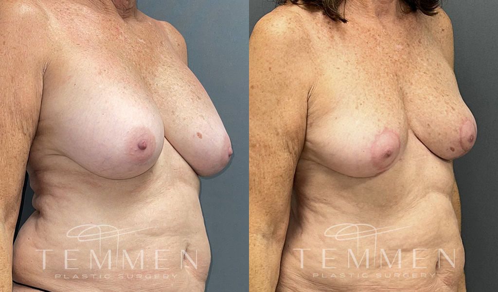 Breast Implant Removal Breast Lift Liposuction Fat Transfer To The Breasts And Tummy Tuck Before & After