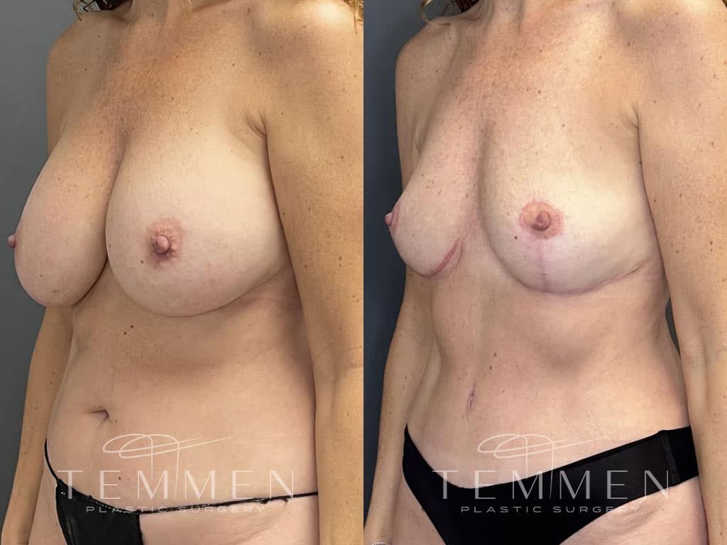Breast Implant Removal Breast Lift Liposuction Fat Transfer To The Breasts And Tummy Tuck Before & After