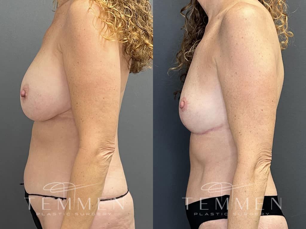 Breast Implant Removal Breast Lift Liposuction Fat Transfer To The Breasts And Tummy Tuck Before & After
