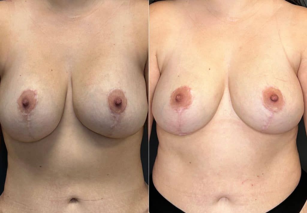 Breast Implant Removal Breast Lift Liposuction Fat Transfer To The Breasts And Tummy Tuck Before & After