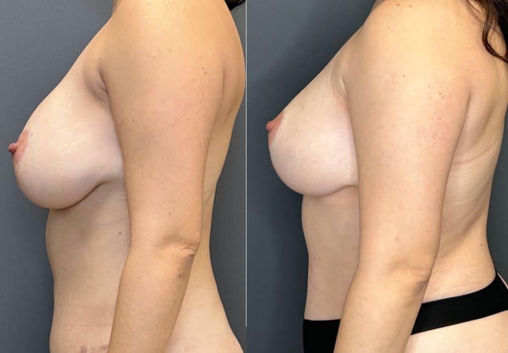 Breast Implant Removal Breast Lift Liposuction Fat Transfer To The Breasts And Tummy Tuck Before & After