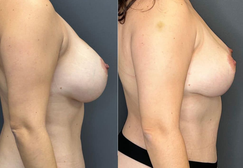 Breast Implant Removal Breast Lift Liposuction Fat Transfer To The Breasts And Tummy Tuck Before & After