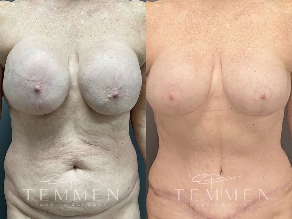 Breast Implant Removal Breast Lift Liposuction Fat Transfer To The Breasts And Tummy Tuck Before & After