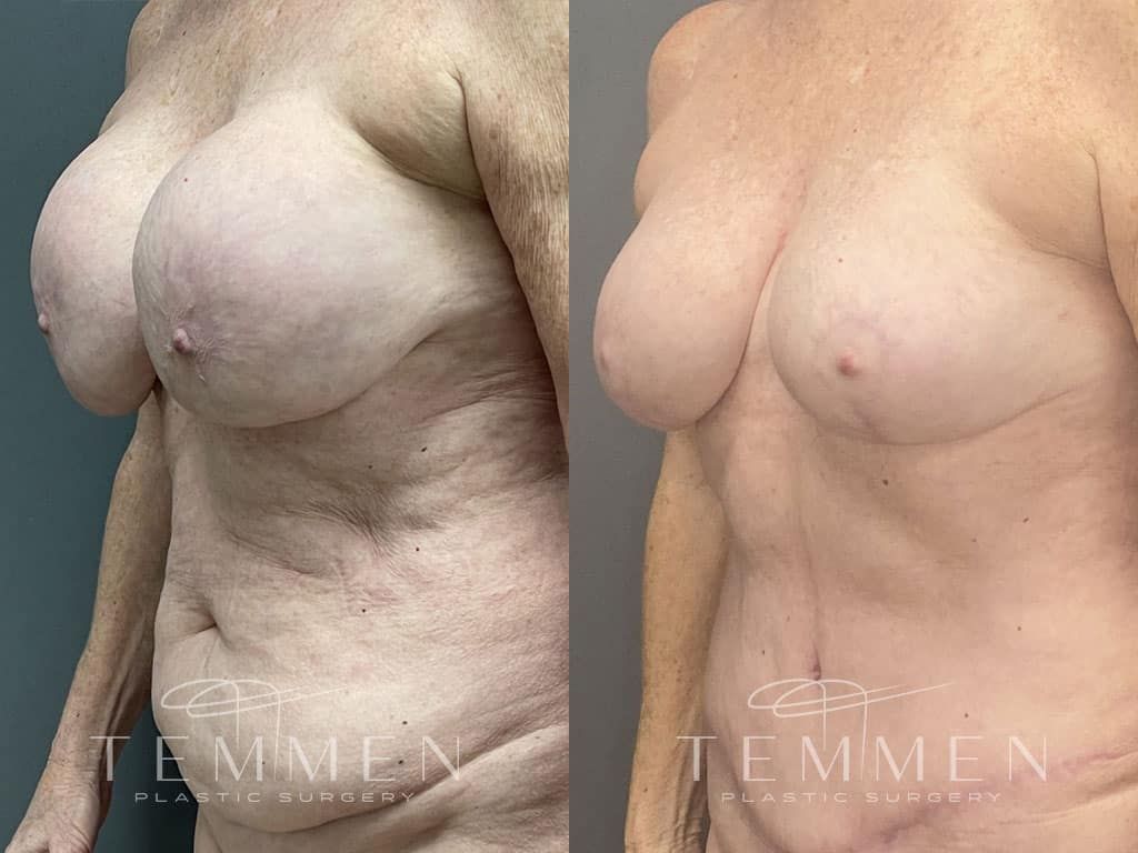 Breast Implant Removal Breast Lift Liposuction Fat Transfer To The Breasts And Tummy Tuck Before & After