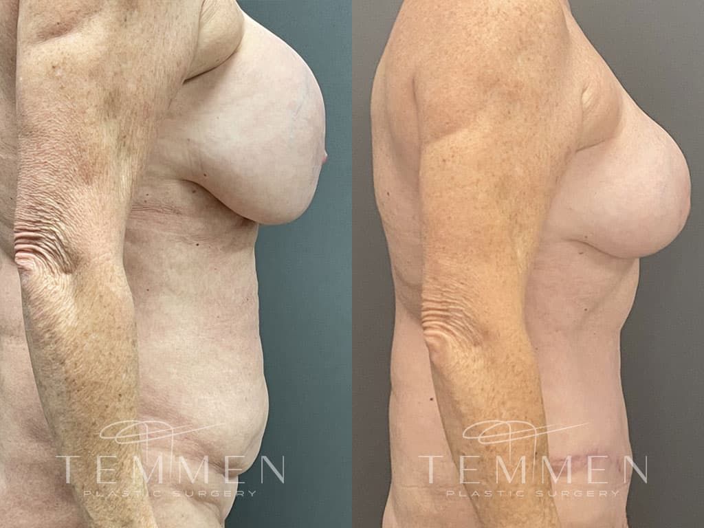 Breast Implant Removal Breast Lift Liposuction Fat Transfer To The Breasts And Tummy Tuck Before & After