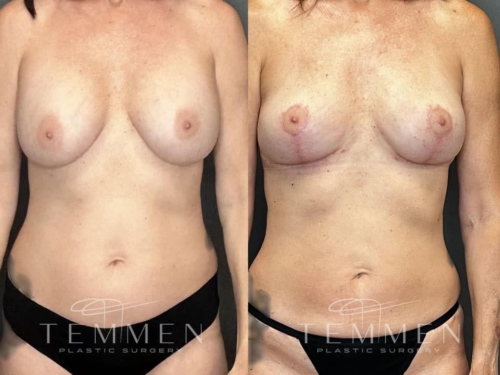 Breast Implant Removal Breast Lift Liposuction Fat Transfer To The Breasts And Tummy Tuck Before & After